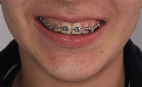 precio brackets metalicos|ortodoncia brackets precio.